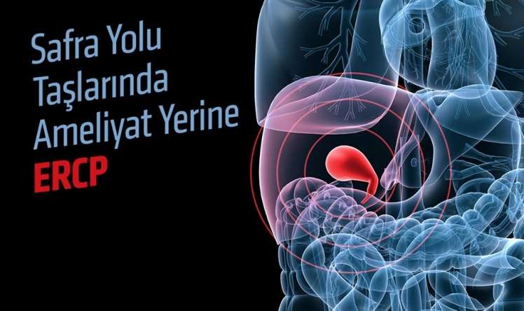 Öd yolu daşlarını əməliyyatsız çıxarırlar –  Yeni ERCP metod