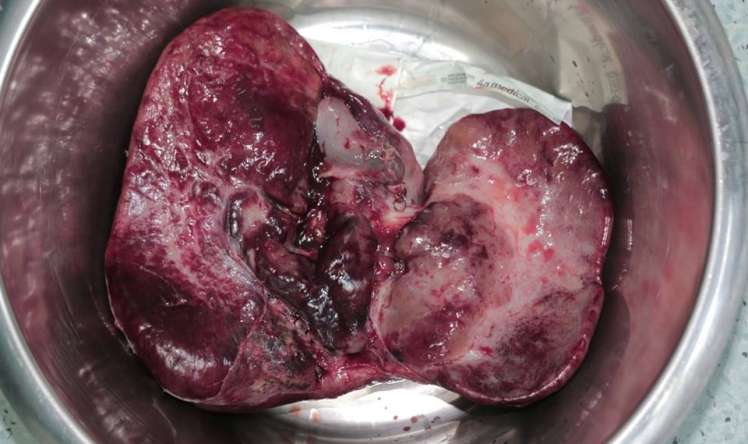 3 yaşlı uşaqdan 2 kiloqram qaraciyər çıxarıldı –  Azərbaycanda qaraciyər transplantasiyası