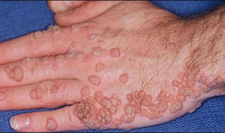  - Bəzi növləri xərçəngə səbəb olur İnsan papilloma virusu nədir?