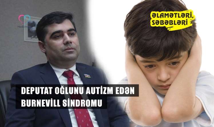 Deputat oğlunu autizm edən Burnevill sindromu -  Müalicəsi yoxdur