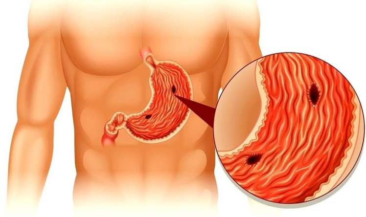 Mədə ağrısının 9 səbəbi -  SİYAHI
