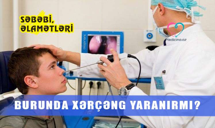 Burunda xərçəng yaranırmı? –  Səbəbi, əlamətləri