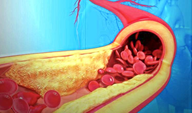 Qanı şəkər, lipid və xolesterindən təmizləyən vasitə -  Damarlarınız güzgü kimi olacaq