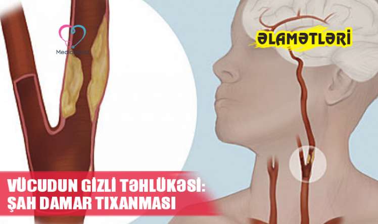 Vücudun gizli təhlükəsi:  ŞAH DAMAR TIXANMASI – Əlamətləri