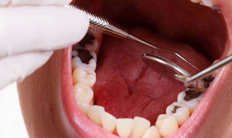 Dişlərin tez çürüməsinə səbəb olan 10 qida  - SİYAHI