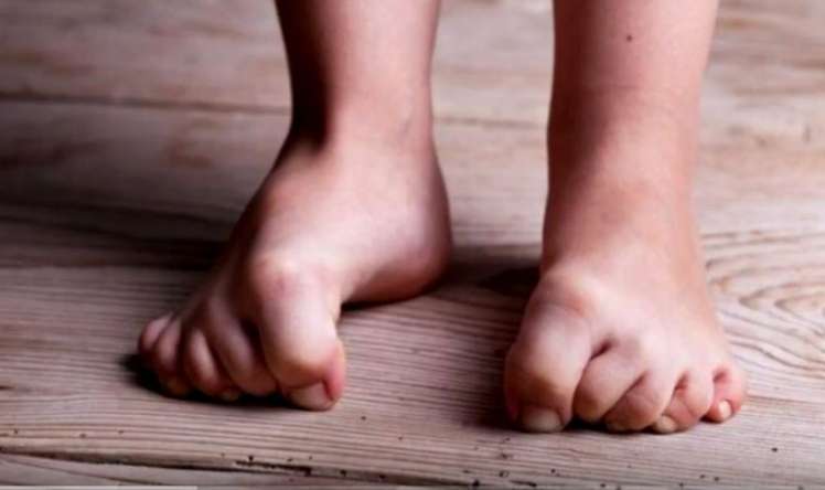Narahat ayaqlar sindromu üçün RESEPT - Ağrıdan yata bilməyənlərə