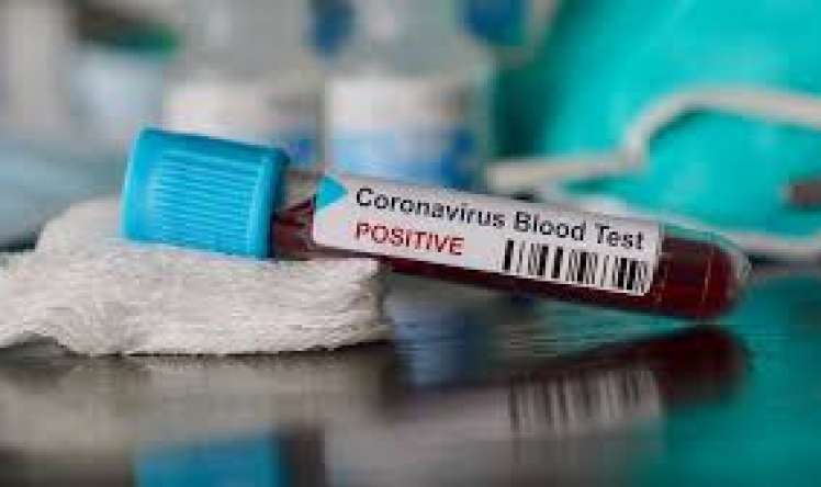 Daha 54 nəfərdə koronavirus aşkarlandı -  Rusiyada