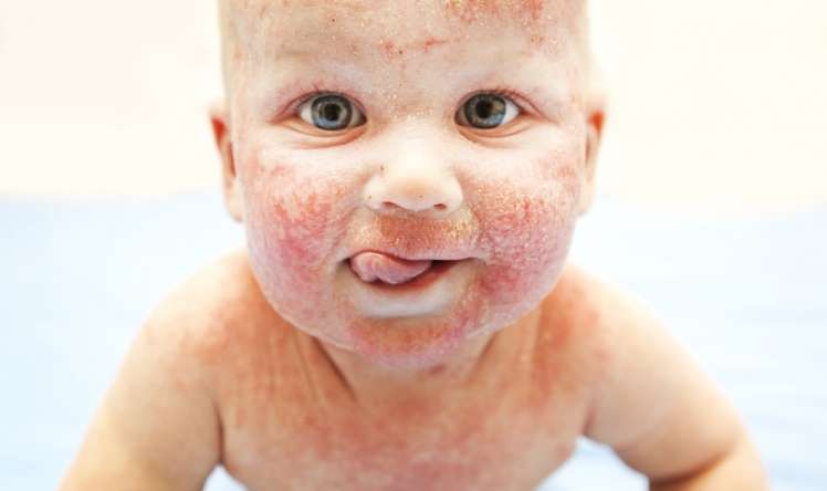 Koronavirus allergiyası olan uşaqlara belə təsir edir  - Həkim açıqlaması