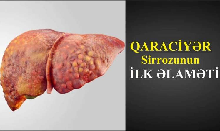 Diqqət: Bunlar qaraciyər sirrozunun əlamətləridir -  VİDEO