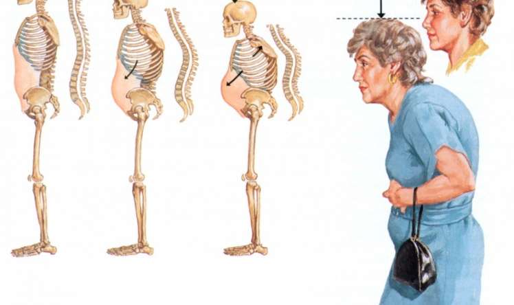 Osteoporozu ciddiyə alıb, qorunmaq lazımdır - Fərqli terapiya