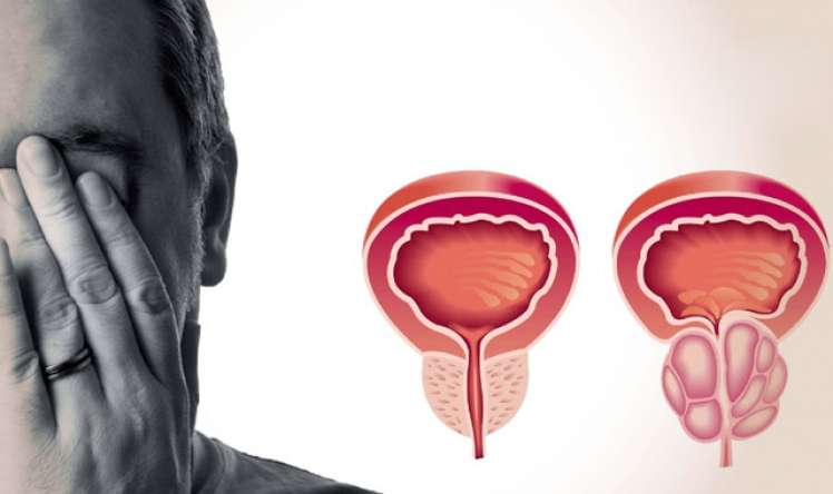 Prostatitin evdə müalicəsi üçün 5 türkəçarə  - Sınanmış RESEPTLƏR - VİDEO