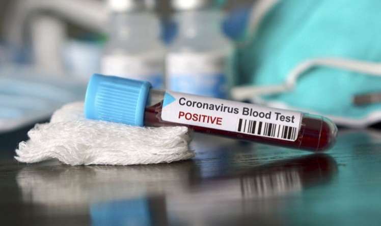 Ermənistanda 1 472 nəfərdə koronavirus aşkarlandı 