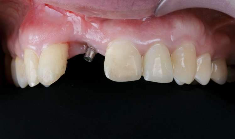 Kimlərə implant diş əkdirmək olmaz?   – Qadağa siyahısı