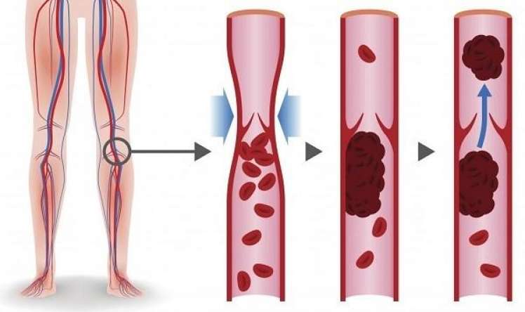 Həkimlər təhlükəli trombozun əlamətini açıqladı  – Öldürə bilər