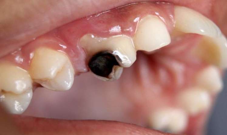 Çürük dişlər ürəyi xəstə edir    - İnfarkt riski
