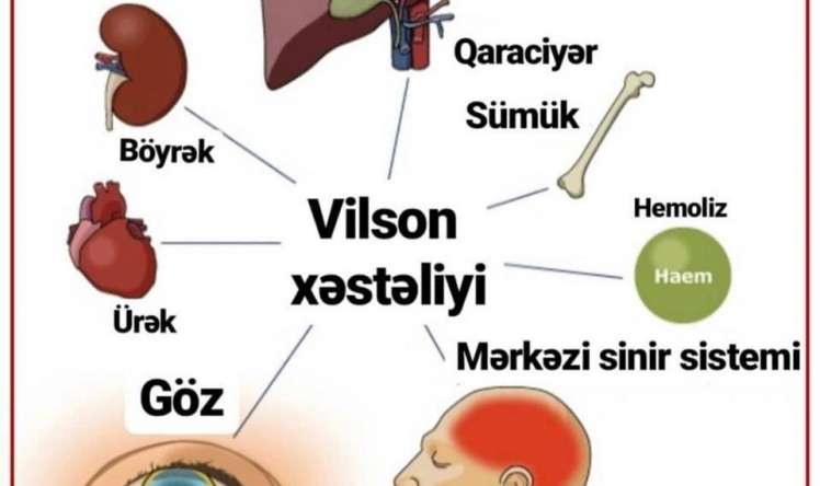 Vilson xəstəliyi nədir? -  Azərbaycanda da rast gəlinən sindrom