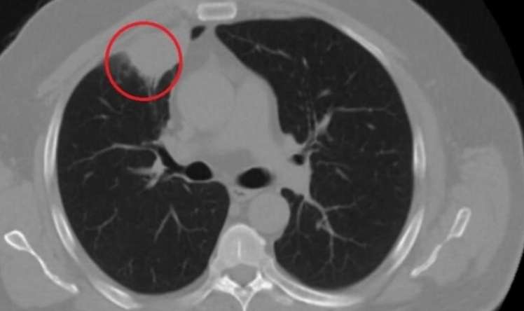 Koronavirus xəstəsinin ağciyərində xərçəngə bənzər şiş yaranıb 