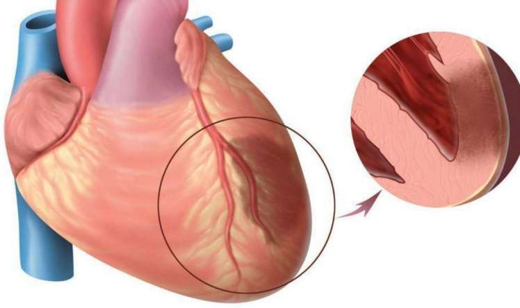 Ayaqüstü keçirilən infarkt -  Tromb damarda qopanda nə baş verir?
