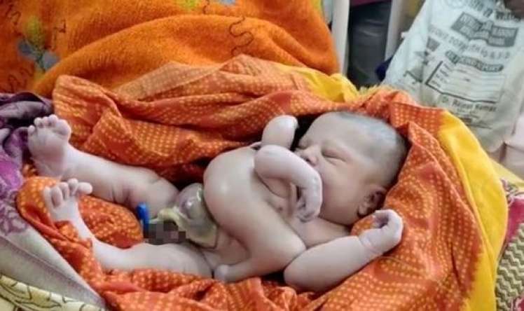 Hindistanda qarnında parazit qardaşı olan daha bir uşaq   doğuldu