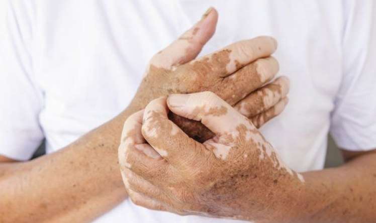 Dermatoloqlar vitiliqonun daha bir səbəbini tapdılar 