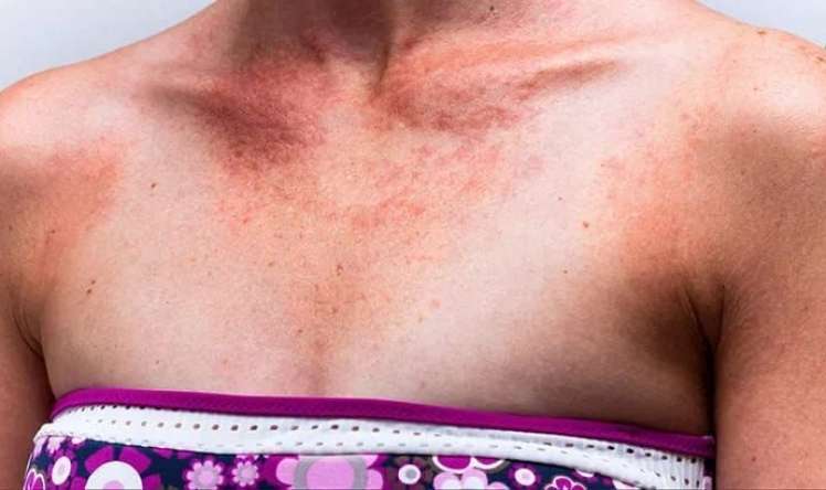 Günəş allergiyasından necə qorunaq? 