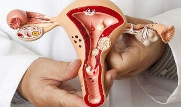 Endometrioz - uşaqlığın iltihabında faydalı    QIDALAR