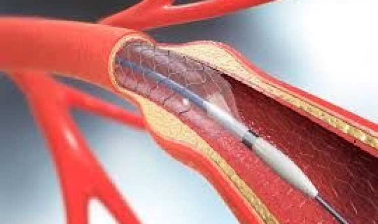 Hansı xəstələrin ürəyinə stent qoymaq olmaz? 