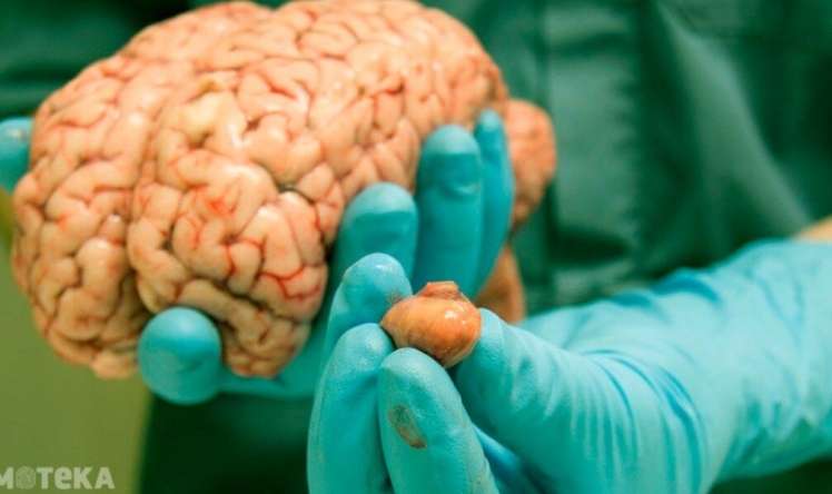  Beyin xərçəngi üçün ən xarakterik simptom  - AÇIQLANDI