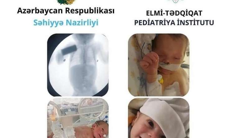 Ağır VACTERL sindromlu körpə müalicə edildi 