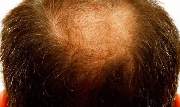 Kişilərdə saç tökülməsinin əsas səbəbləri 