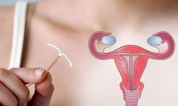 Abort zamanı spiral qoydurmaq olarmı?  – Ginekoloqdan açıqlama
