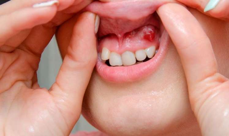 Diş kistləri niyə əmələ gəlir  – Xərçəngə səbəb olurmu?