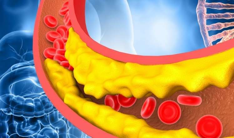 Səssiz qatil  - Xolesterol irsidir