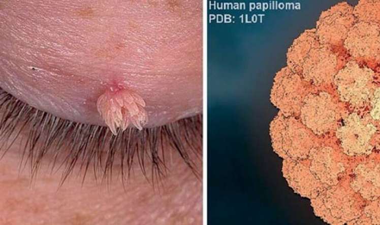 Papilllomavirusların törətdiyi xəstəliklərin müalicəsi   - OMELOTERAPİYA  