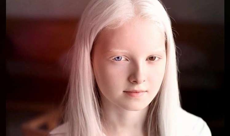 13 iyun - Beynəlxalq Albinostlar günü  - Albinizm nədir? 