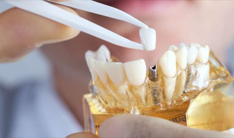 Diş implantlarını neçə müddətdən bir dəyişmək lazımdır? 