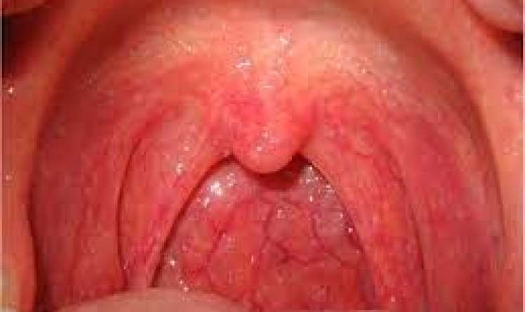 Faringit – adi boğaz ağrısı, yoxsa ciddi xəstəlik? 