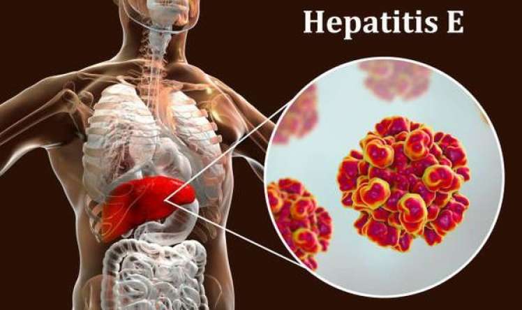 Hepatit E nədir, necə yoluxur? 