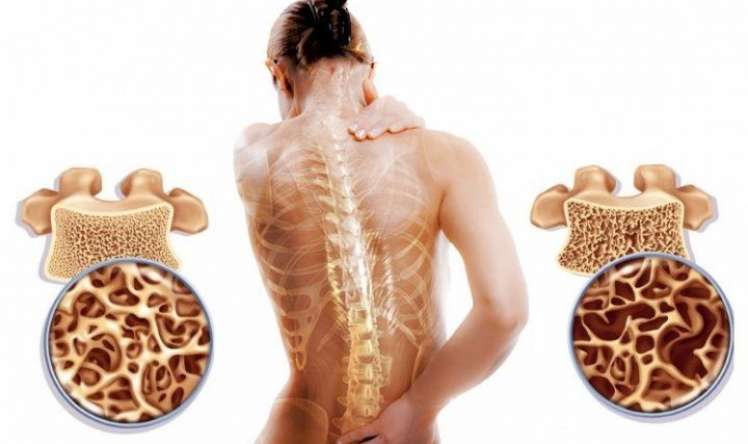 20 oktyabr - Osteoporozla mübarizə günü   - Sümük əriməsi nədir? 