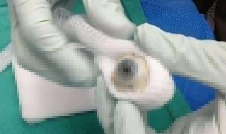 Tibdə ilk: Göz transplantasiyası keçirildi 