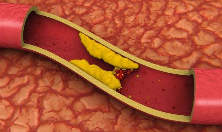 Xolesterinin ən pis formasını 90% azaldan  dərman tapıldı
