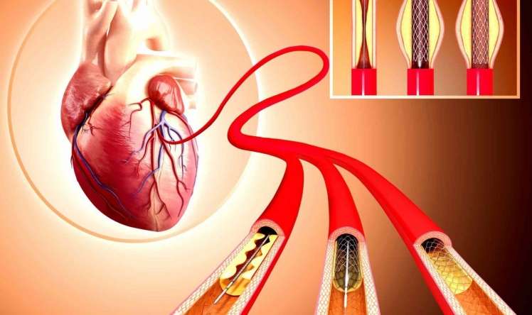 Azərbaycanda hər 5 nəfərdən birinin ürəyində stent var - AÇIQLAMA