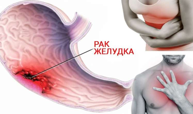 Kişilərdə qanazlığı onkoloji prosesdən  - xəbər verə bilər