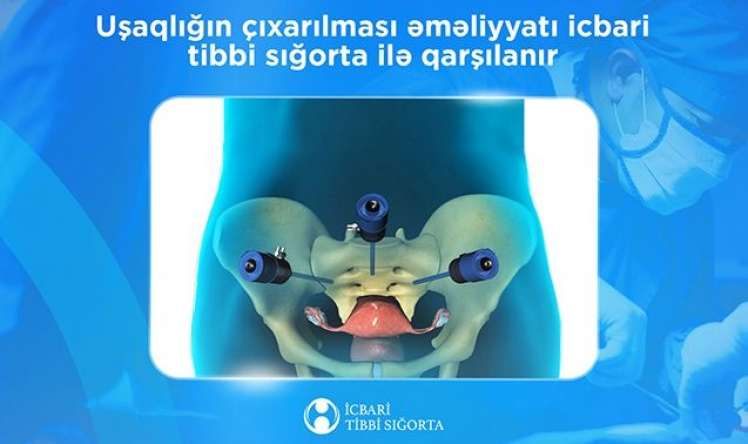Daha bir əməliyyat  İcbari tibbi sığorta ilə qarşılanacaq