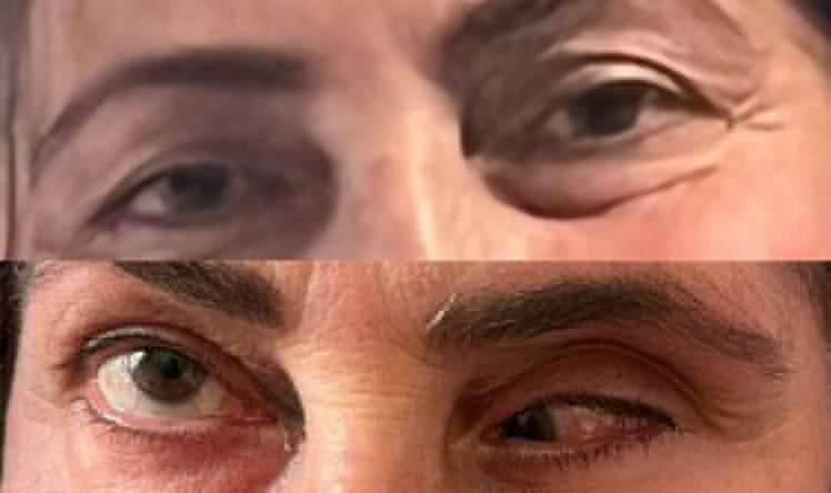 Burun əməliyyatından sonra gözündə çəplik yarandı -  Pasiyent ŞİKAYƏTİ - FOTO