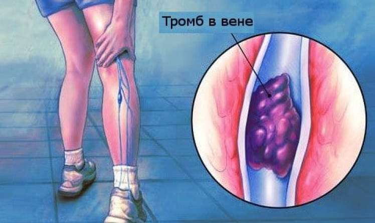 Təhlükəli tromb: O, öskürəklə başlayır:  
