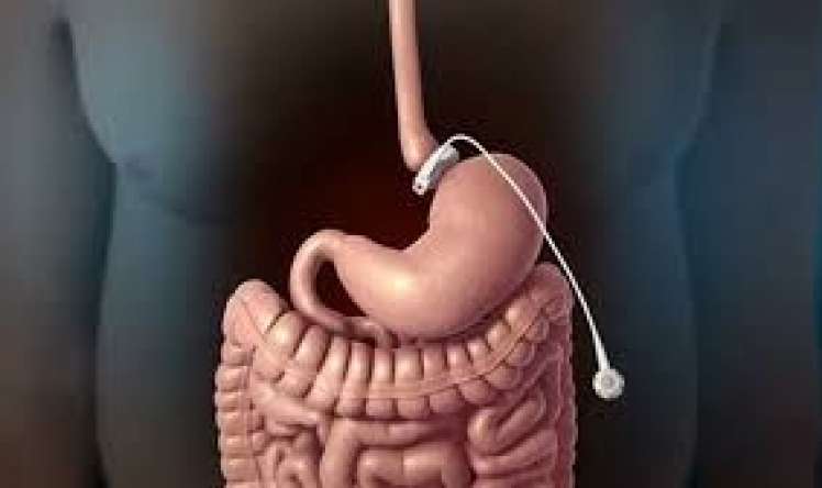 Mədə şuntlanması nədir? 