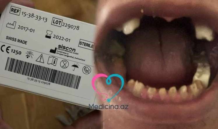  Həm dişlərini itirdi, həm də 8700 manatını  – Stomatoloq pasiyenti fəlakətə sürüklədi