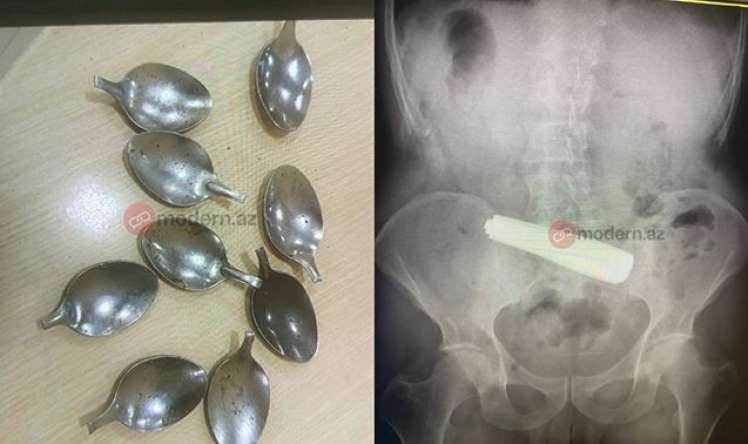 Bakı sakini 9 ədəd qaşıq uddu -  FOTO