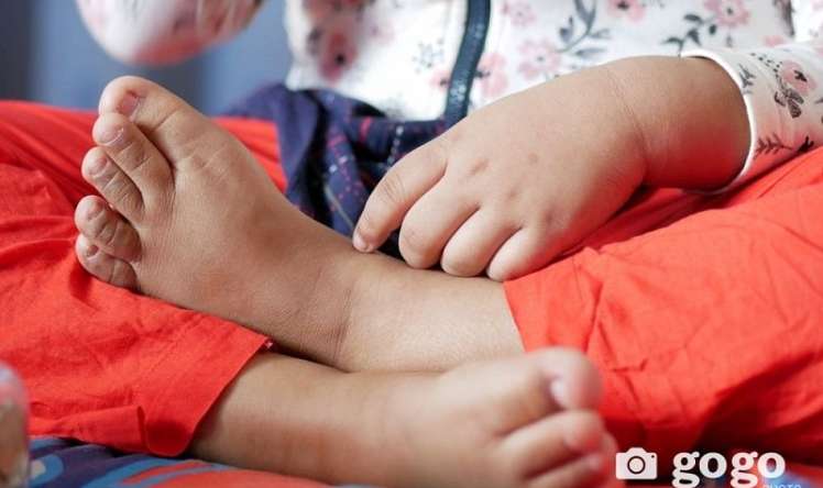 Bu ölkədə qızılca epidemiyası alovlandı 